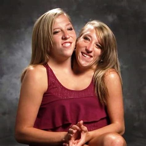 conjoined twins dating abby